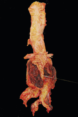 medicalschool:  This is an image of a ruptured abdominal aortic