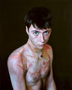 Doug Auld, Portraits of burn survivors.