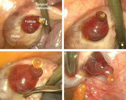 sarahlalah:  Moment of ovulation accidentally photographed during