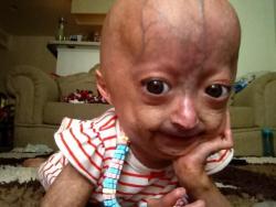 iconichubela:  This is Adalia Rose. She’s 5 years old and has