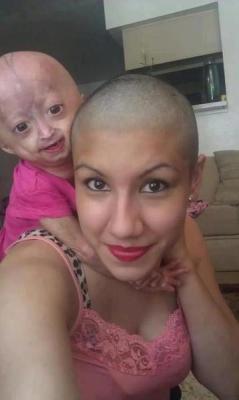 Esta é Adalia Rosa. Ela tem 5 anos e tem síndrome de progeria.