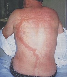  Lichtenberg figures - Scars after being struck by lightning.