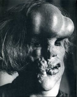 Elephant Man (John Hurt) par Lord Snowdon.