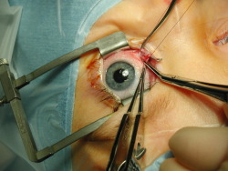 eyeeyesir:  Surgery to remove the medial rectus muscle. 