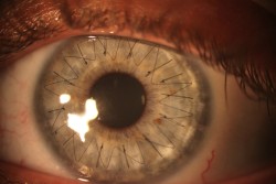  haezle:  youngoutfitters:   My girlfriend recently got a cornea