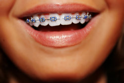 Braces (y)