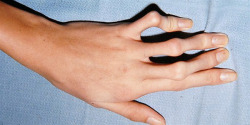 motherapist:  Arachnodactyly (“spider fingers”) is a condition