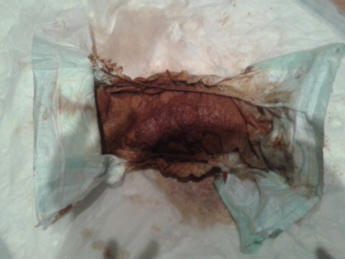 My girlfiendÂ´s diaper when she waked up she is with diarrea