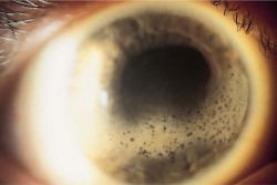 eyedefects:Band keratopathy, a deposition of calcium, is seen