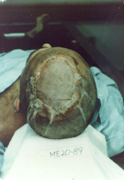 fallenmilkteeth:  Ted Bundy’s head and leg burns caused by