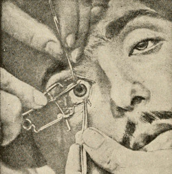 sutured-infection:  Irridectomy, from Henry D. Noyes’s A textbook