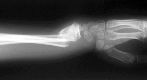 colles vs smith fracture mnenomics colles vs smith fracture mnenomics