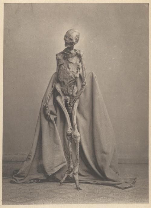 Photograph of found bog body of 1873. The body had been found in 1871 in the Heidmoor