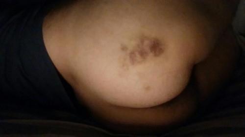 The nice bruise on my ass that showed up a couple days after daddy had me spank myself with my dildo