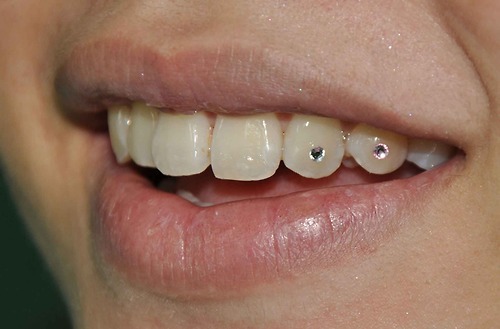 euo:  Two Skyce crystals were attached to the incisor and canine teeth. Skyce crystals