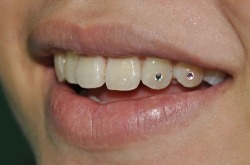 Euo:  Two Skyce Crystals Were Attached To The Incisor And Canine Teeth. Skyce Crystals