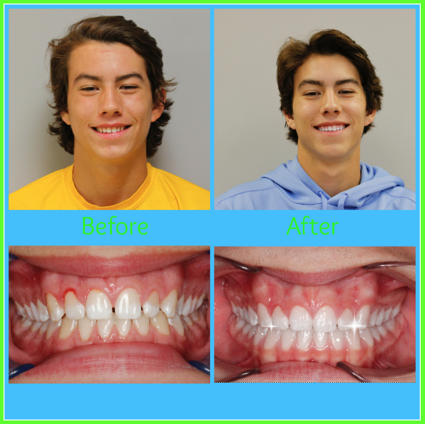 Congratulations Carter on completing your aligner therapy! #smilemakerortho