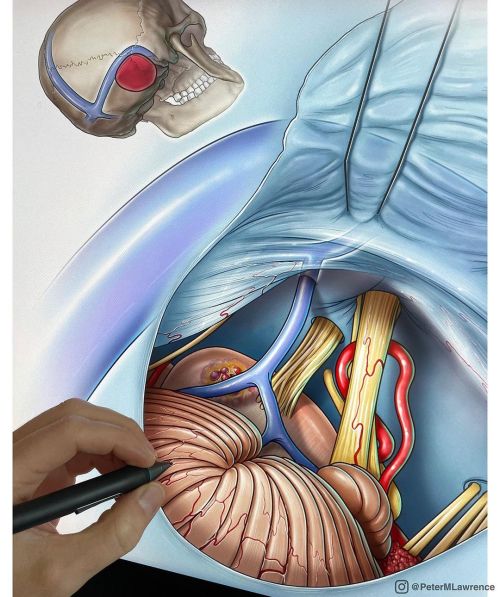 Work in progress depicting the extended retrosigmoid/trans-cerebellopontine angle approach to peritr