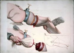 dichotomized:  Leg amputation in an 1821 illustration by the Scottish surgeon Charles Bell. The tourniquet was there to numb the pain and reduce blood flow, but this could also lead to serious tissue damage.