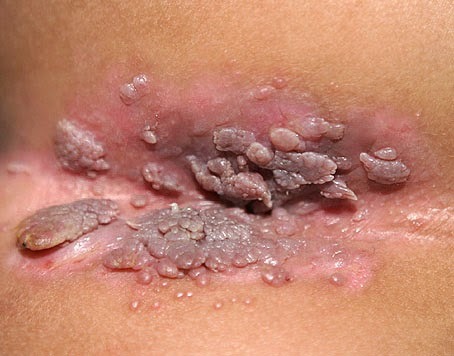 Genital warts on penis