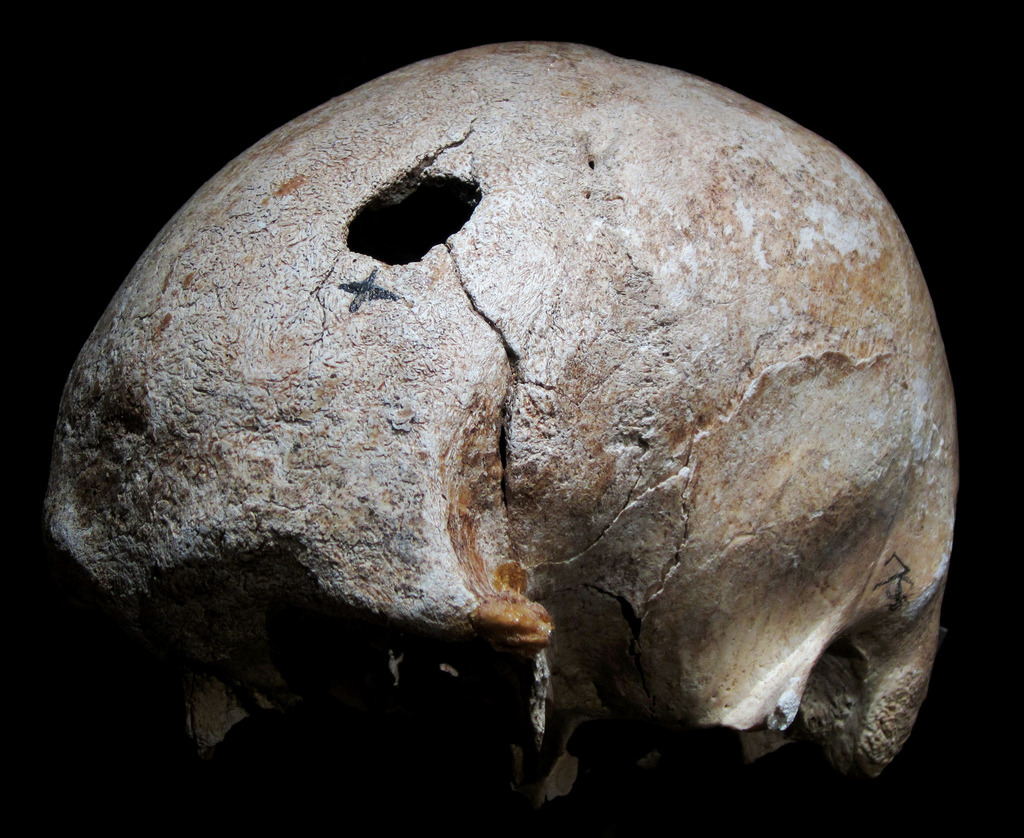 emt-monster:  Healed head injuries from sword blows (meaning they survived the injury)