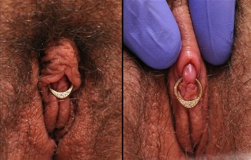 Triangle piercing (under the clit), clithood retracted (by the piercer, fresh piercing?).