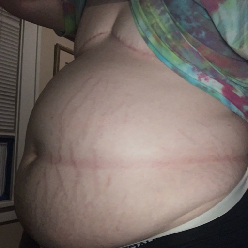 Stuffedandswollen:pov: You’ve Just Stuffed Your Feedee Until Her Bloated Gut Is