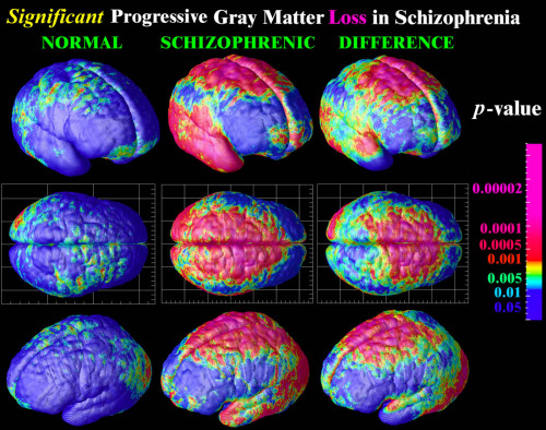 willrgaham: Schizophrenia is a psychosis, a type of mental illness in which a person canno