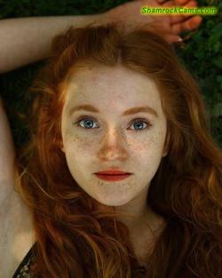 frecklesarebrilliant:Freckles are brilliant