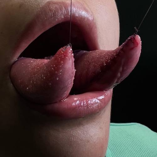 allthepiercingsandbodymods:Tongue split by Oscarmarquezbodymod.