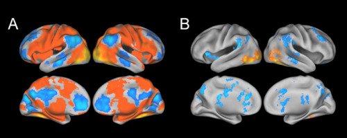 (Image caption: Shown are fMRI scans across all subjects in the study. The yellow and red areas in S