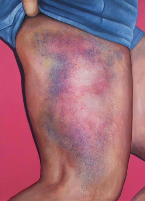 thingstolovefor:    Riikka Hyvönen taps into an unexpected kind of beauty in the athletes who send her shots of the bruises (or “kisses” in roller derby terms) they wear like badges of honour, turning these photographs into large-scale sculptural