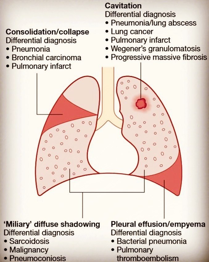 doctordconline: Some of lungs pathology and their localization…  #pathology  #lungs