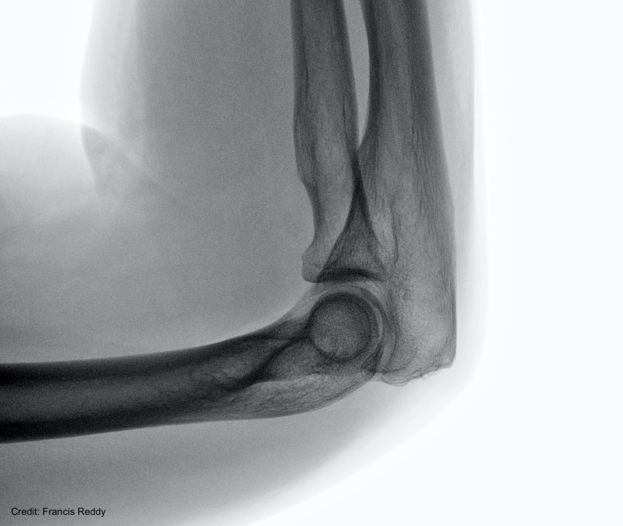 X-ray image of a human elbow. Denser materials, like bone, stop more X-rays than skin and muscle.