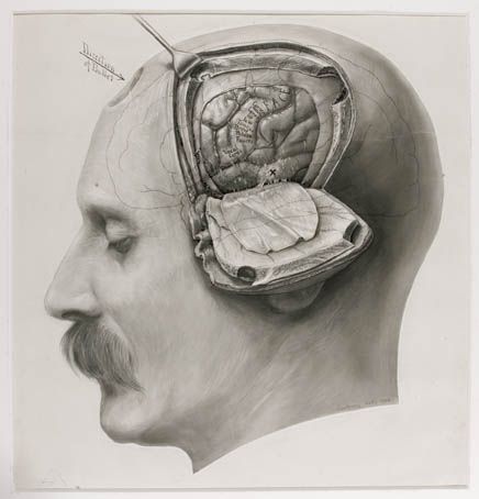 photograph/drawing/diagram of the human head that had undergone craniectomy. Revealing the temp