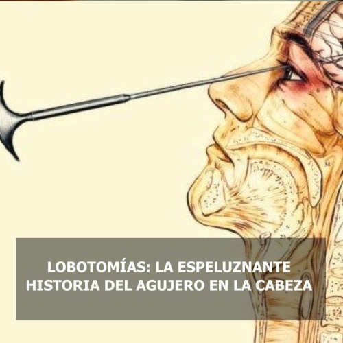 El procedimiento tenía como objetivo cortar las conexiones con el lóbulo frontal del c