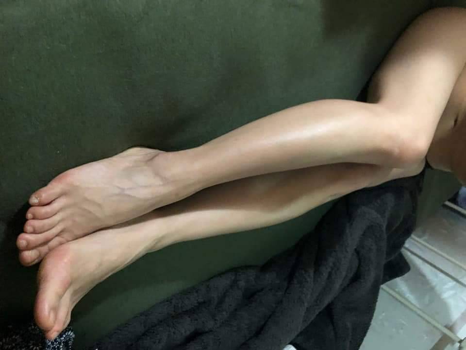 香港腳趾迷