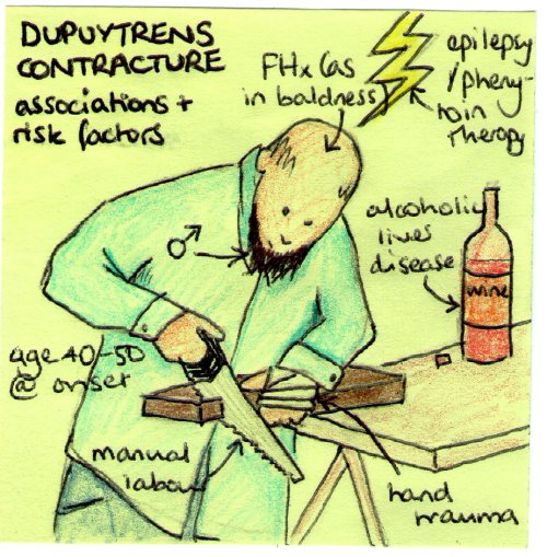 Some associations of Dupuytrens contracture that are useful to be aware of. Some are well establishe