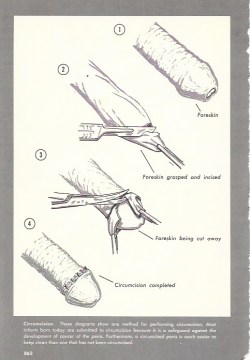 circumcisionrequired:  dixwell-me:Taken from a medical encyclopedia from the 1960s.   No inner foreskin preserved with this method.   The ultra low &amp; tight is also known as “the beauty cut” as the scar isn’t visible on the shaft  Inner skin