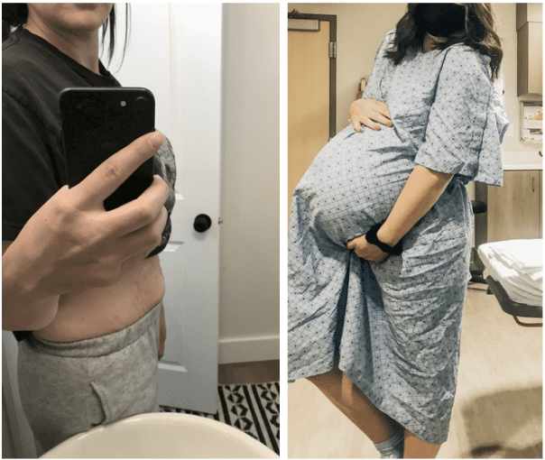 Before & After Photos – Belly Bandit