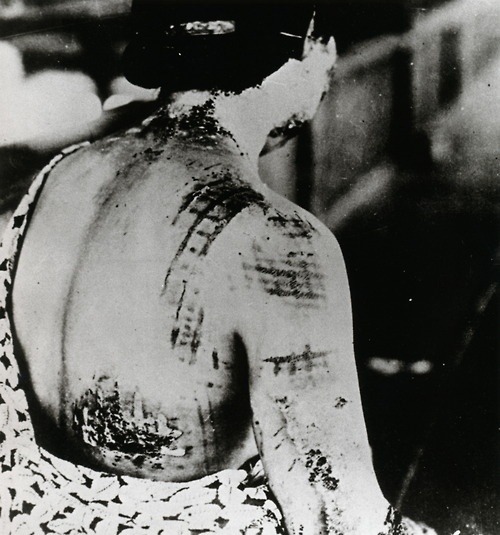 A Japanese woman awaits treatment, her back scarred by the patten of the dress she