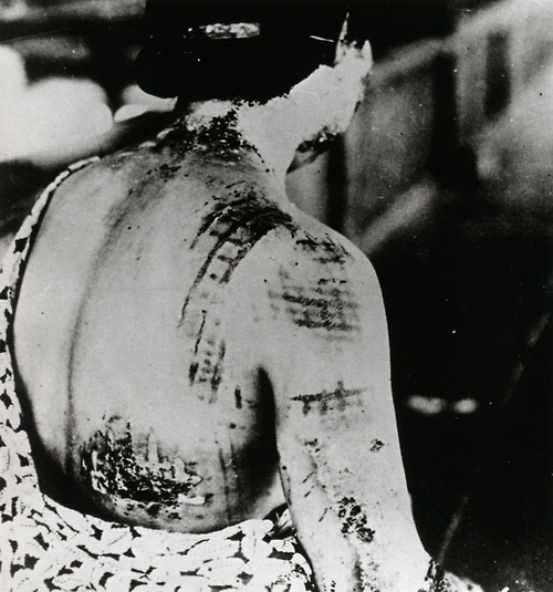 A Japanese woman awaits treatment, her back scarred by the patten of the dress she was wearing when the world’s first atomic bomb used in warfare fell on Hiroshima on August 6, 1945. Since white colors repelled the bomb’s heat and dark colors absorbed