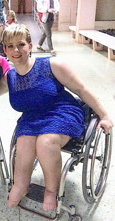 Gorgeous spina bifida girl with chubby legs.