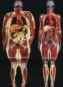 Wow! Body scan of 250 pound woman and 120 pound woman. If this isn&rsquo;t motivation to work out, I don&rsquo;t know what is!! Note to self: Look at the size of the intestines and stomach; how the knee joints are rubbing together; the enlarged heart;