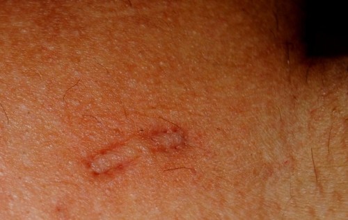 My bite marks. adult photos