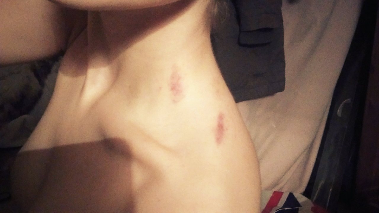 pup-pyrus:  Hickeys courtesy of @cephalopup last night. You should leave some more