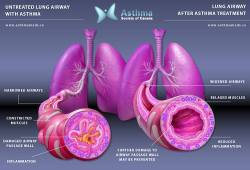 anatomyandphysiology101:   When an asthma attack  happens, the airway of the lungs swell because  they become inflamed and produce an extra thick mucus which makes  breathing very difficult. Your chest tightens which causes shortness of  breath, wheezing