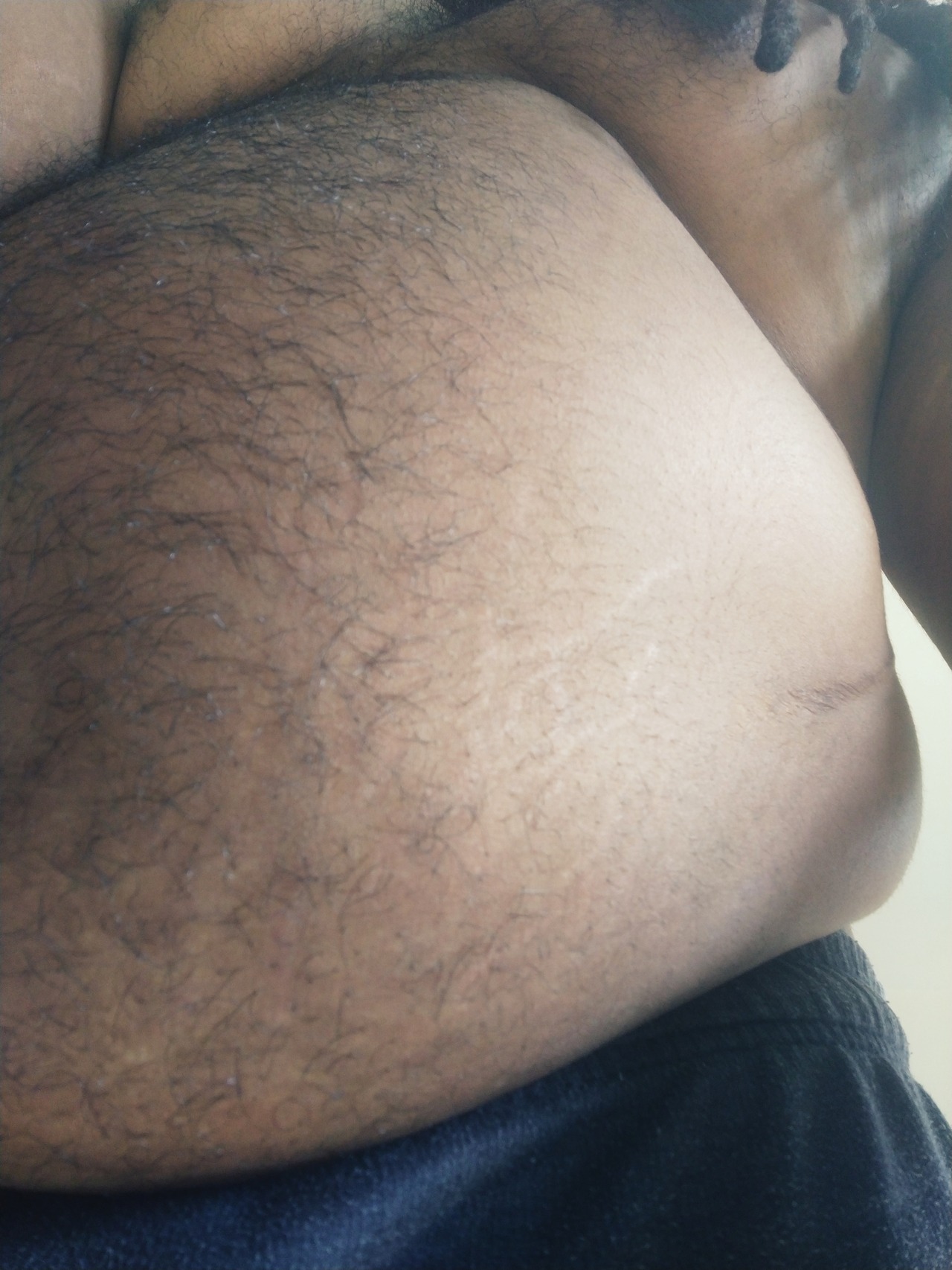 thegourmetgainer:  I promise there are new stretch marks there! My fuzz is hiding