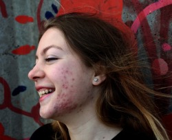 hiraeeeth:some photos of my photoproject which is called “Redefining beauty ” which wants to identificate people with acne and to break the beauty standarts together! 