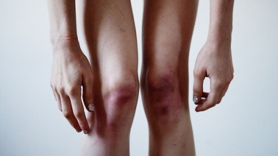 #skinny body#skinny legs#bruises#bruisy legs#bruisylegs#skinny girl